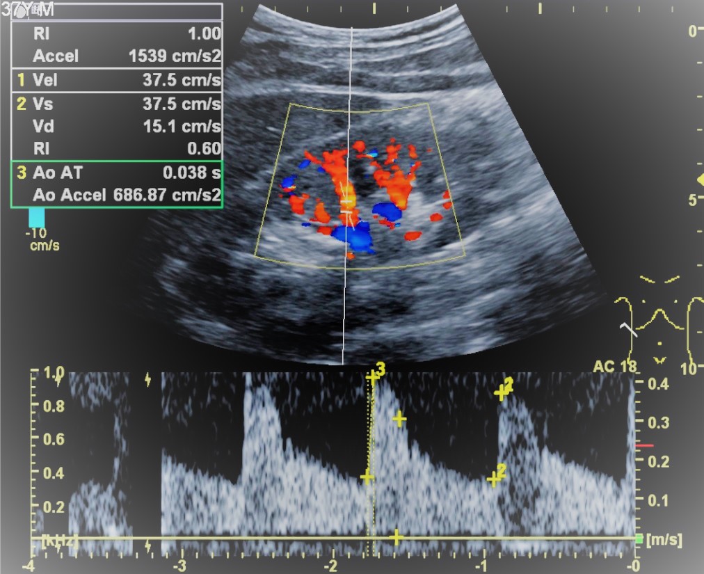 Nyaki Erek Doppler Ultrahang