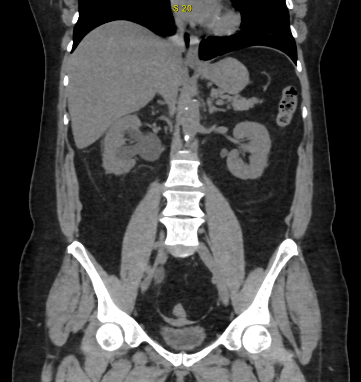 CT Urográfia